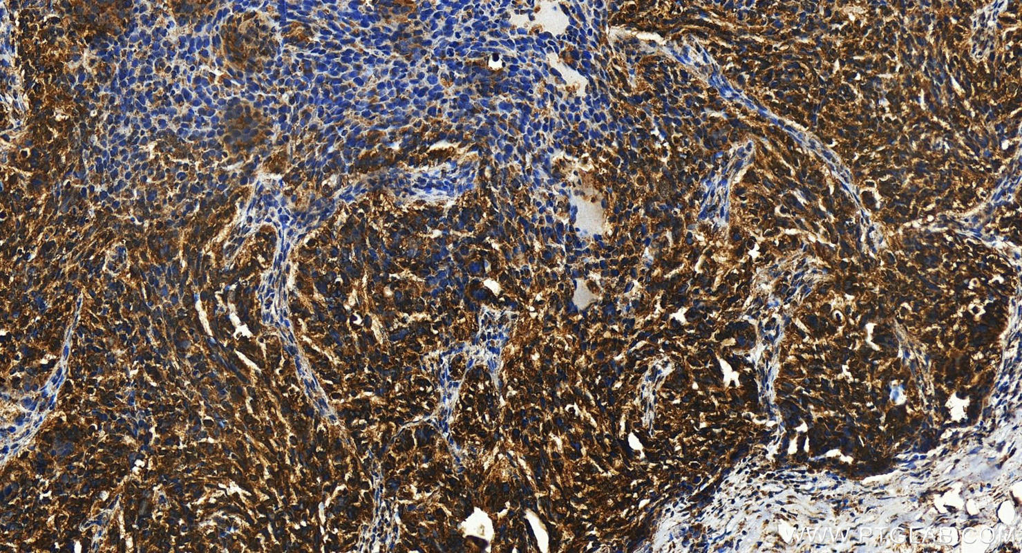 IHC staining of human ovary cancer using 16767-1-AP