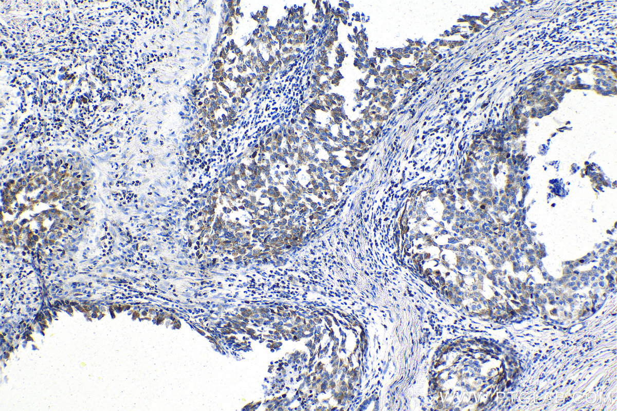 IHC staining of human breast cancer using 17300-1-AP