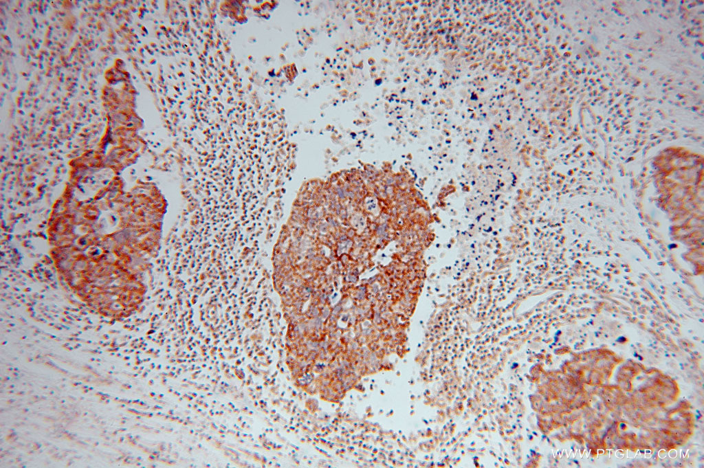 IHC staining of human ovary tumor using 16394-1-AP