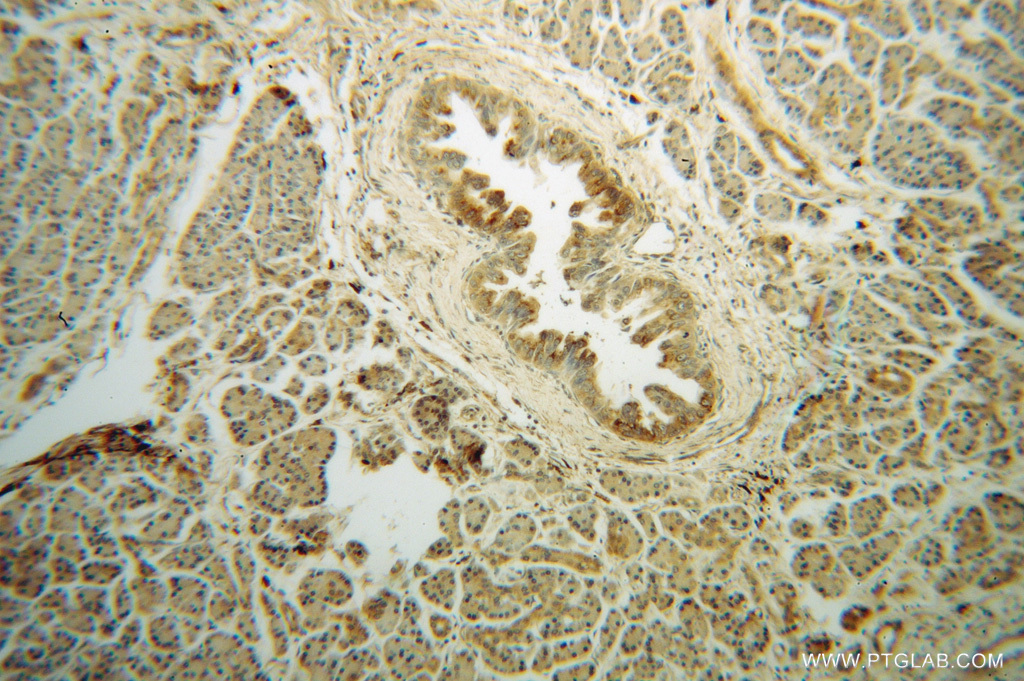 IHC staining of human pancreas cancer using 14677-1-AP