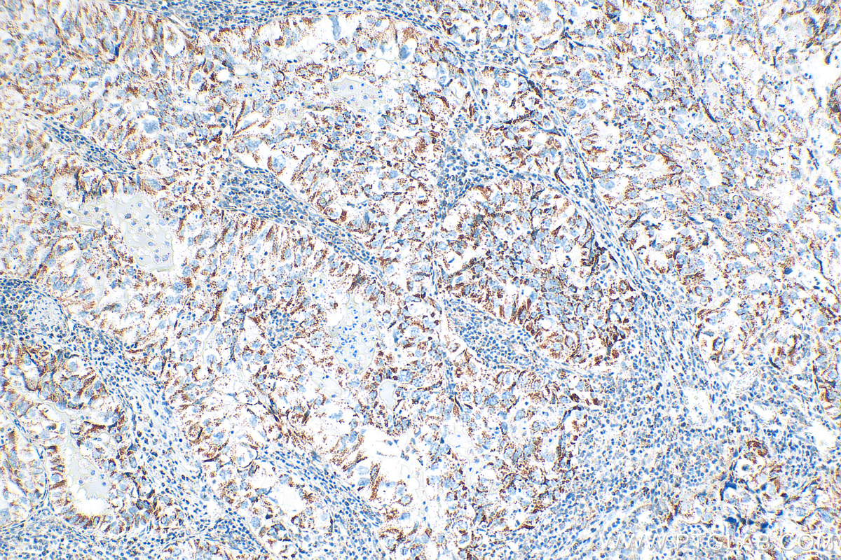 IHC staining of human lung cancer using 83565-1-RR (same clone as 83565-1-PBS)