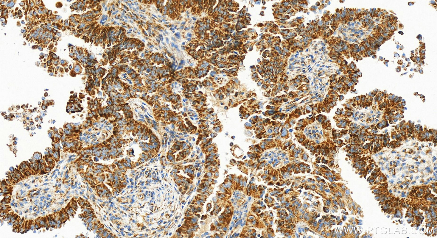 IHC staining of human ovarian cancer using 83565-1-RR (same clone as 83565-1-PBS)
