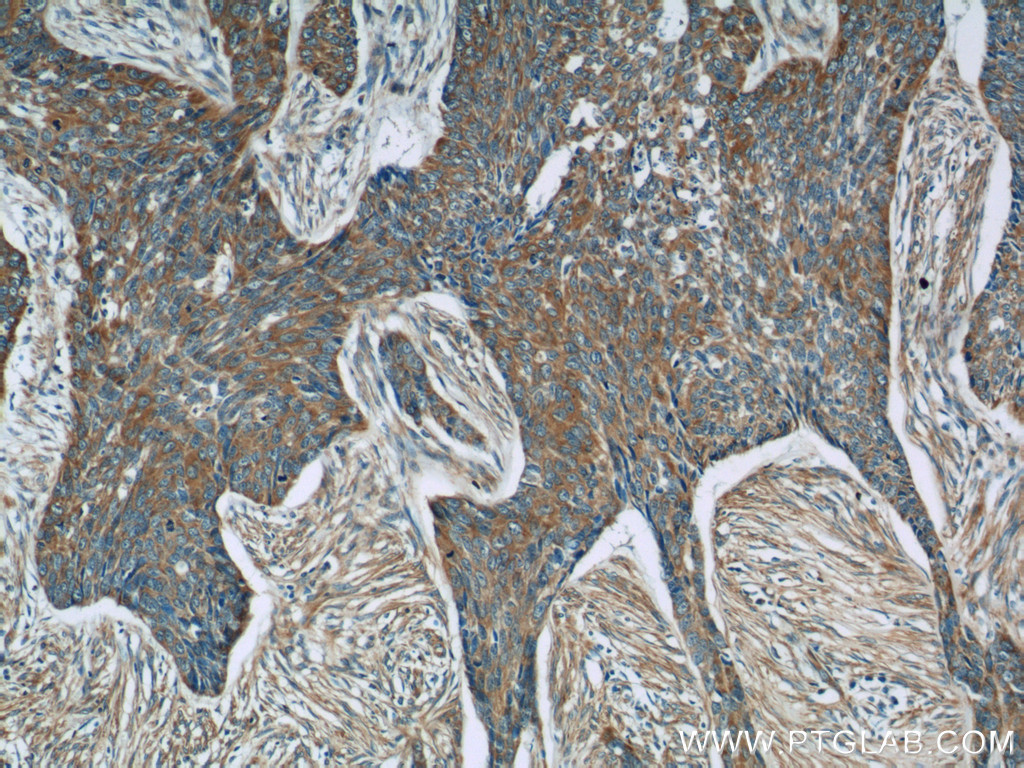 IHC staining of human skin cancer using 16142-1-AP