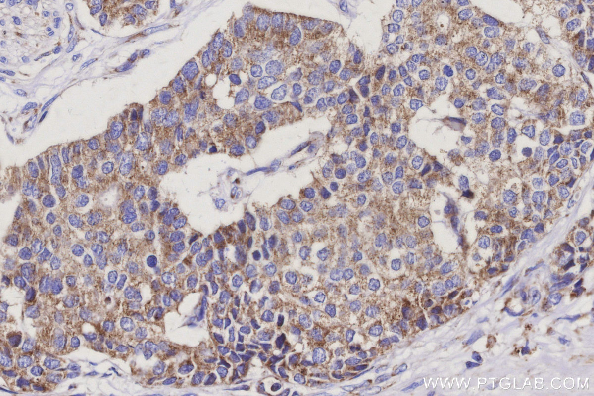 IHC staining of human stomach cancer using 16301-1-AP IHC staining of human stomach cancer using 16301-1-AP
