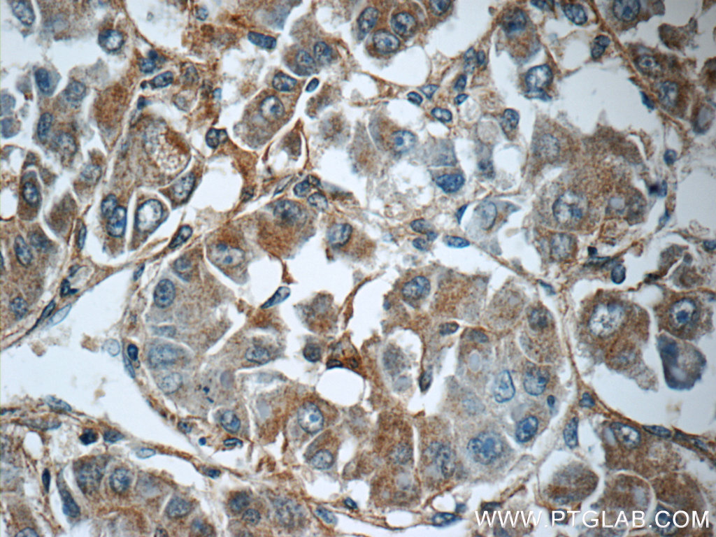 IHC staining of human liver cancer using 15989-1-AP