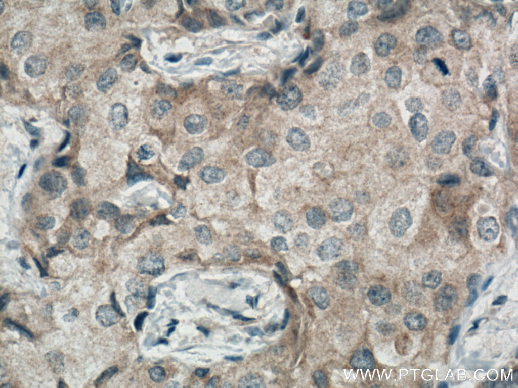 IHC staining of human breast cancer using 66724-1-Ig (same clone as 66724-1-PBS)