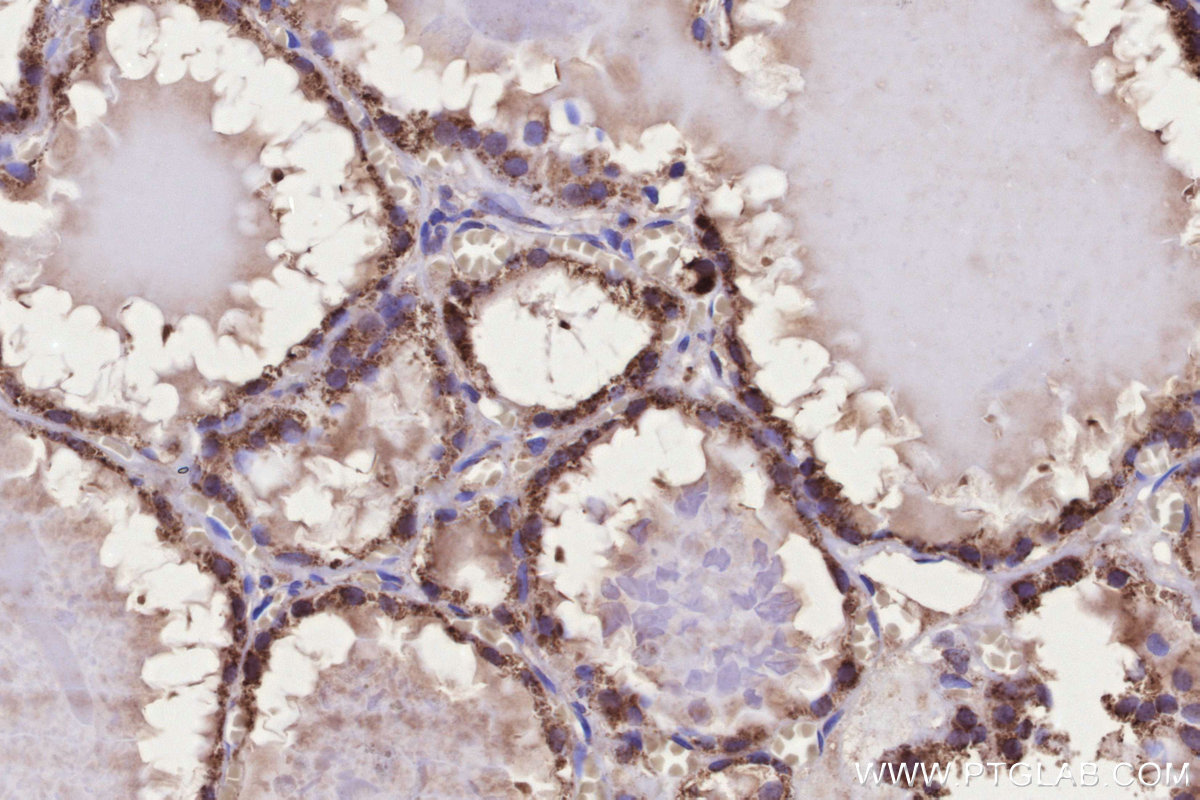 IHC staining of human thyroid cancer using 16288-1-AP IHC staining of human thyroid cancer using 16288-1-AP