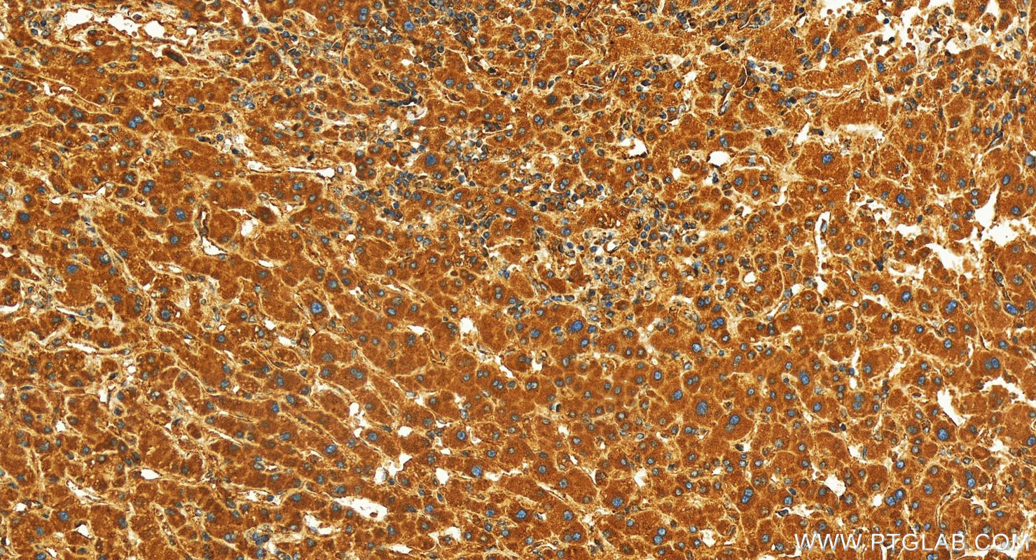 IHC staining of human intrahepatic cholangiocarcinoma using 16273-1-AP