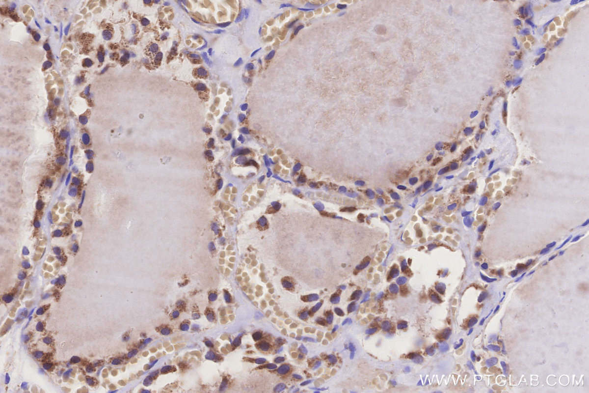 IHC staining of human thyroid cancer using 16273-1-AP IHC staining of human thyroid cancer using 16273-1-AP