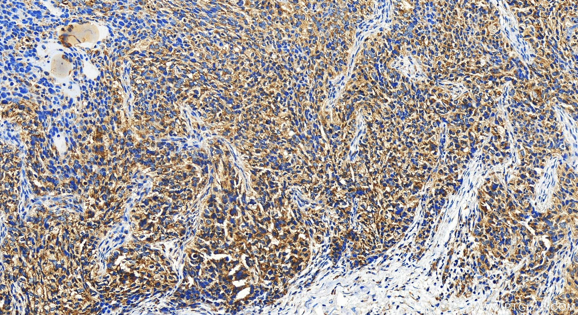 IHC staining of human ovary cancer using 16273-1-AP