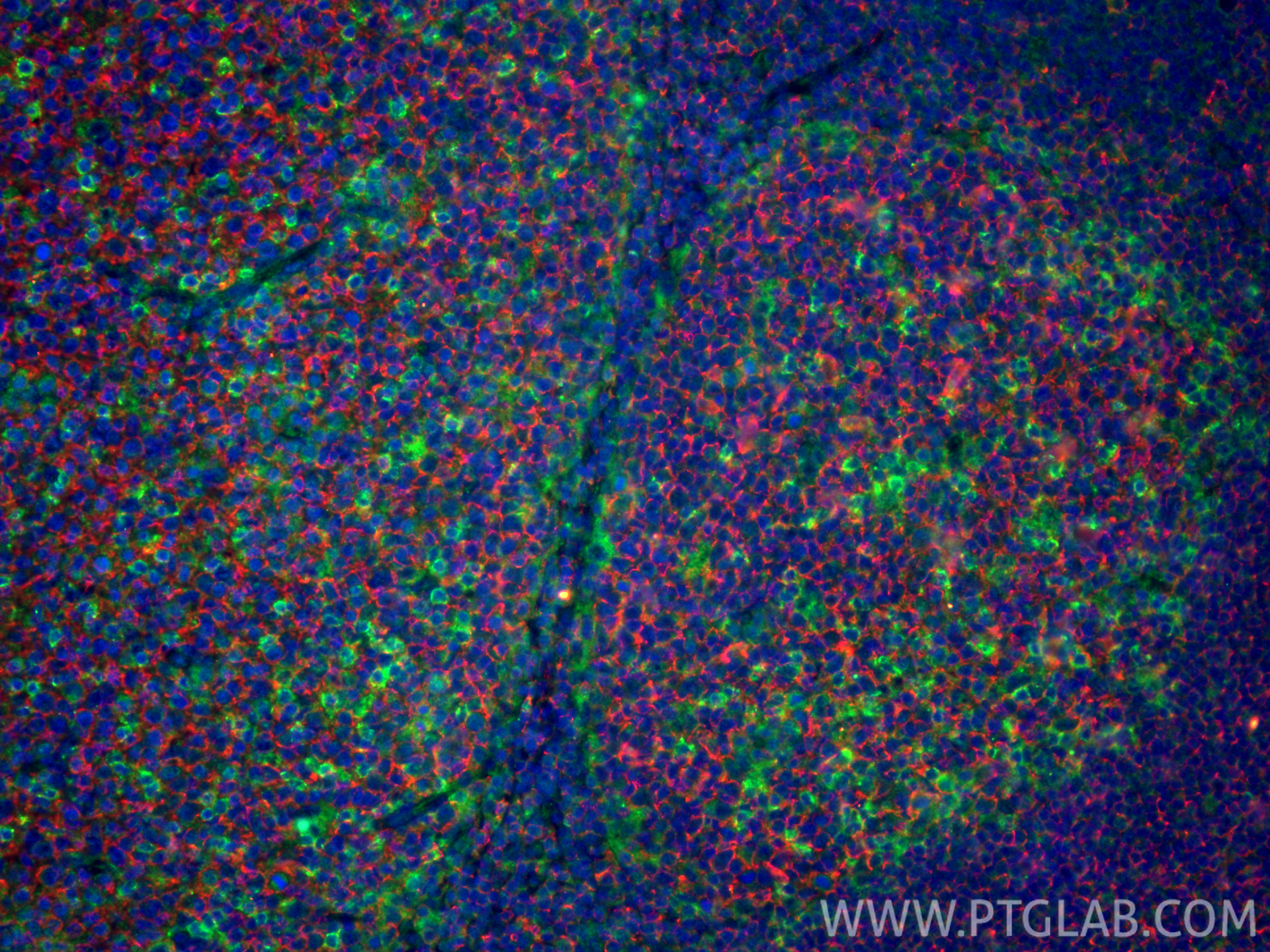 IF Staining of human tonsillitis using 60271-1-Ig