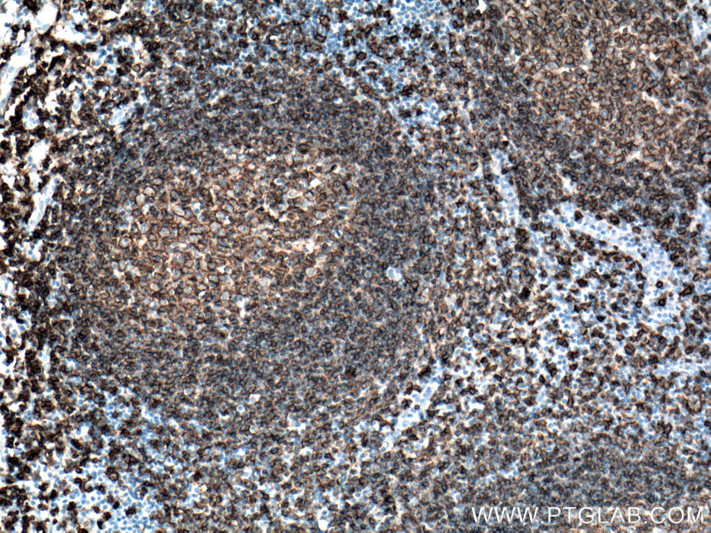 IHC staining of human tonsillitis using 60271-1-Ig (same clone as 60271-1-PBS)