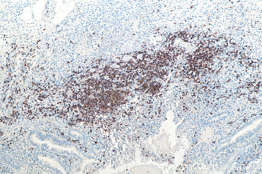 IHC staining of human appendicitis using 60271-1-Ig IHC staining of human appendicitis using 60271-1-Ig