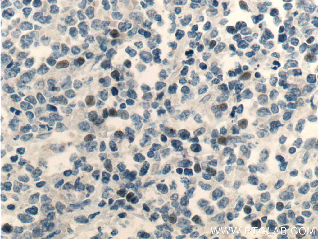 IHC staining of human lymphoma using 25028-1-AP