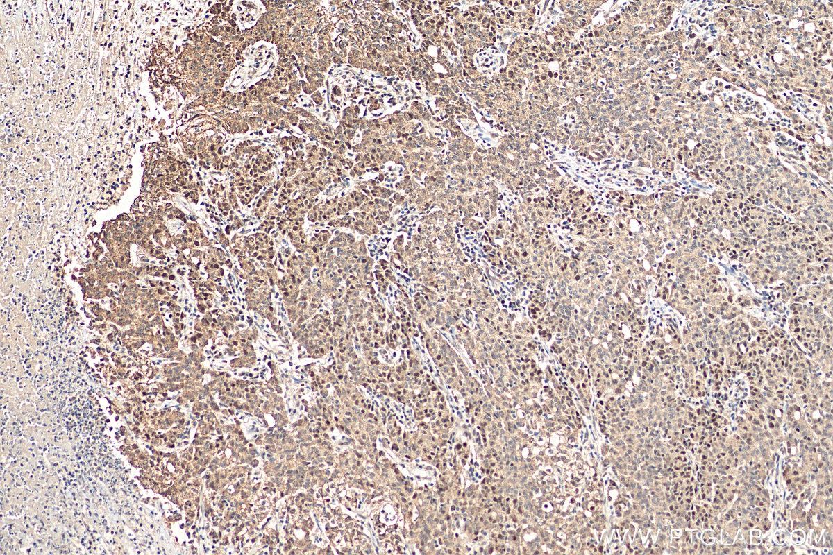 IHC staining of human stomach cancer using 15520-1-AP