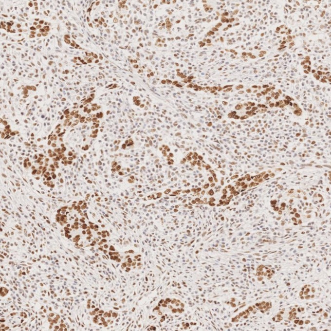 IHC staining of human stomach cancer using 82775-1-RR