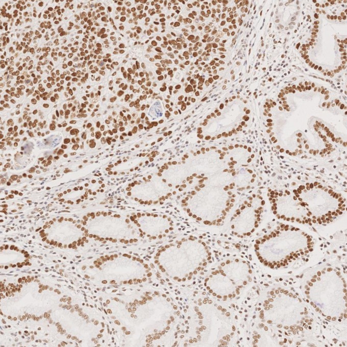 IHC staining of human stomach cancer using 82775-1-RR