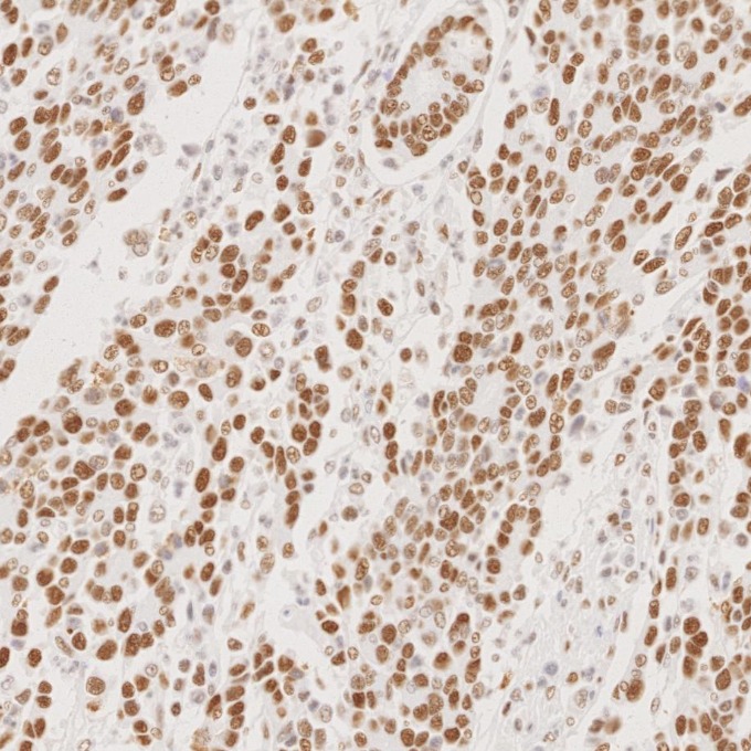 IHC staining of human stomach cancer using 82775-1-RR
