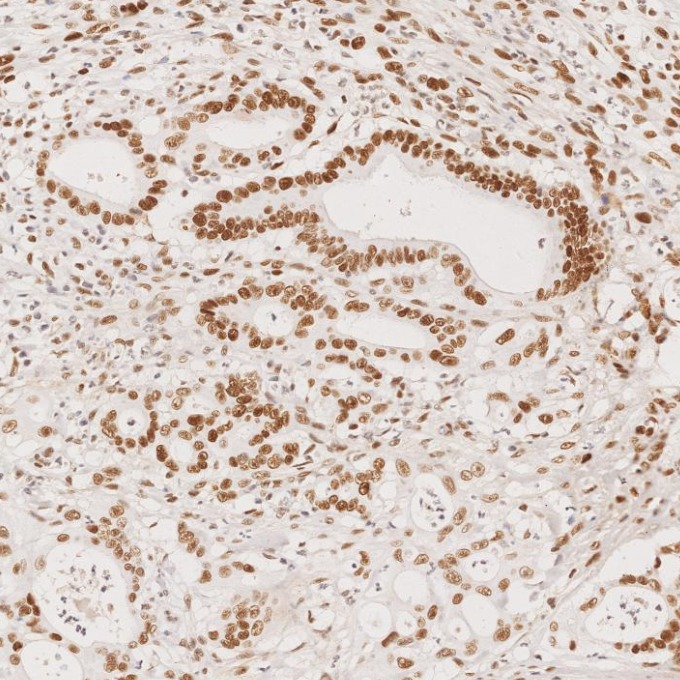 IHC staining of human colorectal cancer using 82775-1-RR