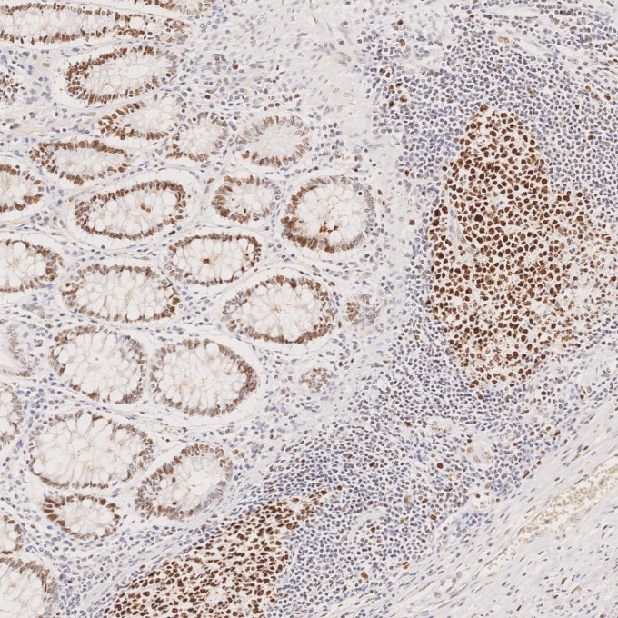 IHC staining of human colorectal cancer using 82775-1-RR