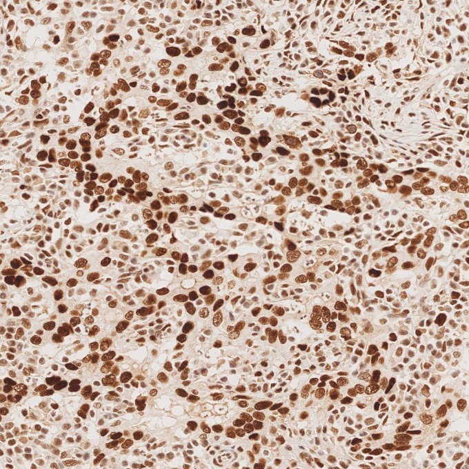 IHC staining of human stomach cancer using 82775-1-RR