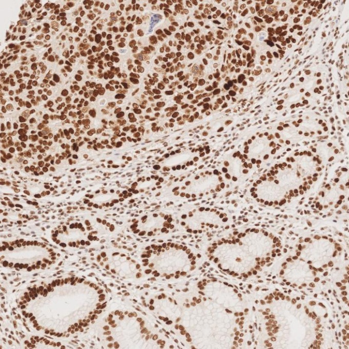 IHC staining of human stomach cancer using 82775-1-RR