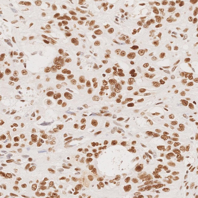 IHC staining of human ovary cancer using 82775-1-RR
