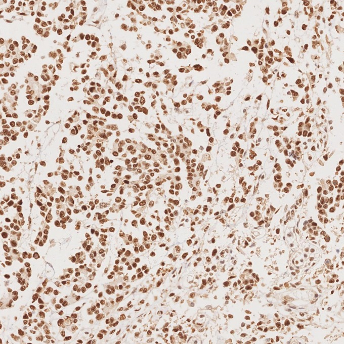 IHC staining of human stomach cancer using 82775-1-RR
