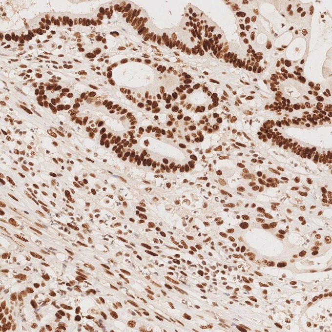 IHC staining of human colorectal cancer using 82775-1-RR
