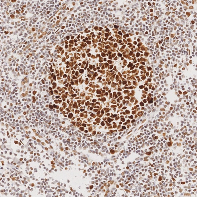 IHC staining of human tonsillitis using 82775-1-RR