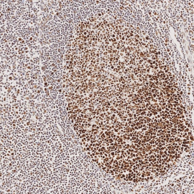 IHC staining of human tonsillitis using 82775-1-RR