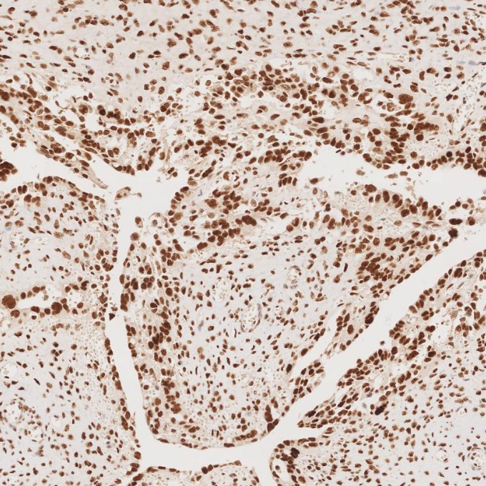 IHC staining of human ovary cancer using 82775-1-RR