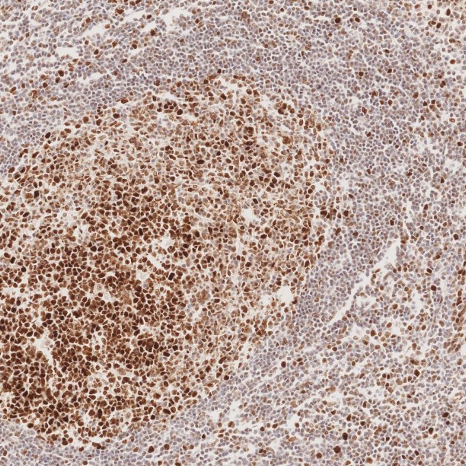 IHC staining of human tonsillitis using 82775-1-RR