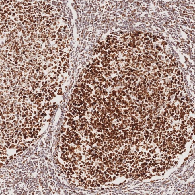 IHC staining of human tonsillitis using 82775-1-RR