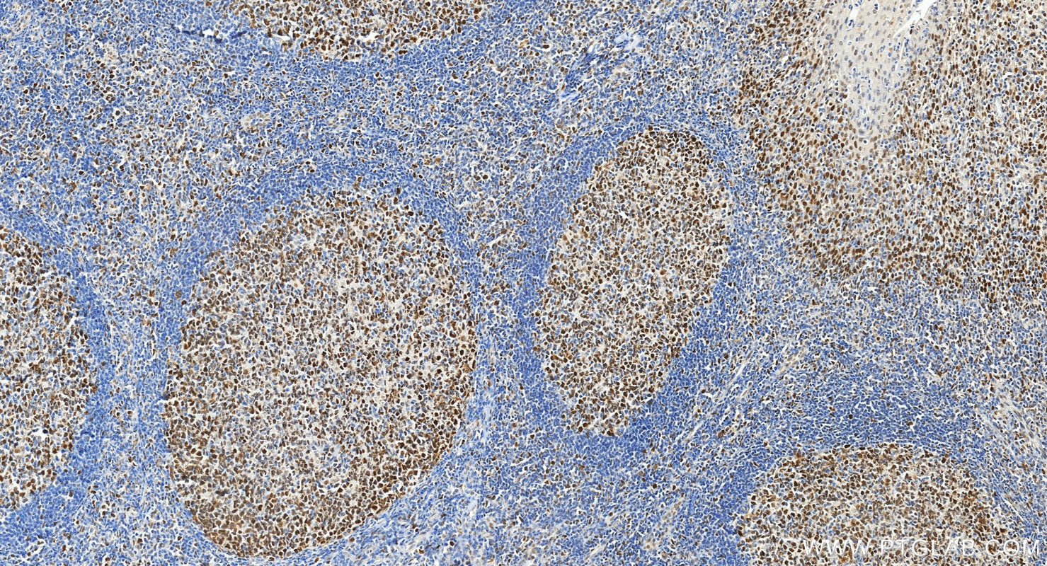 IHC staining of human tonsillitis using 18120-1-AP