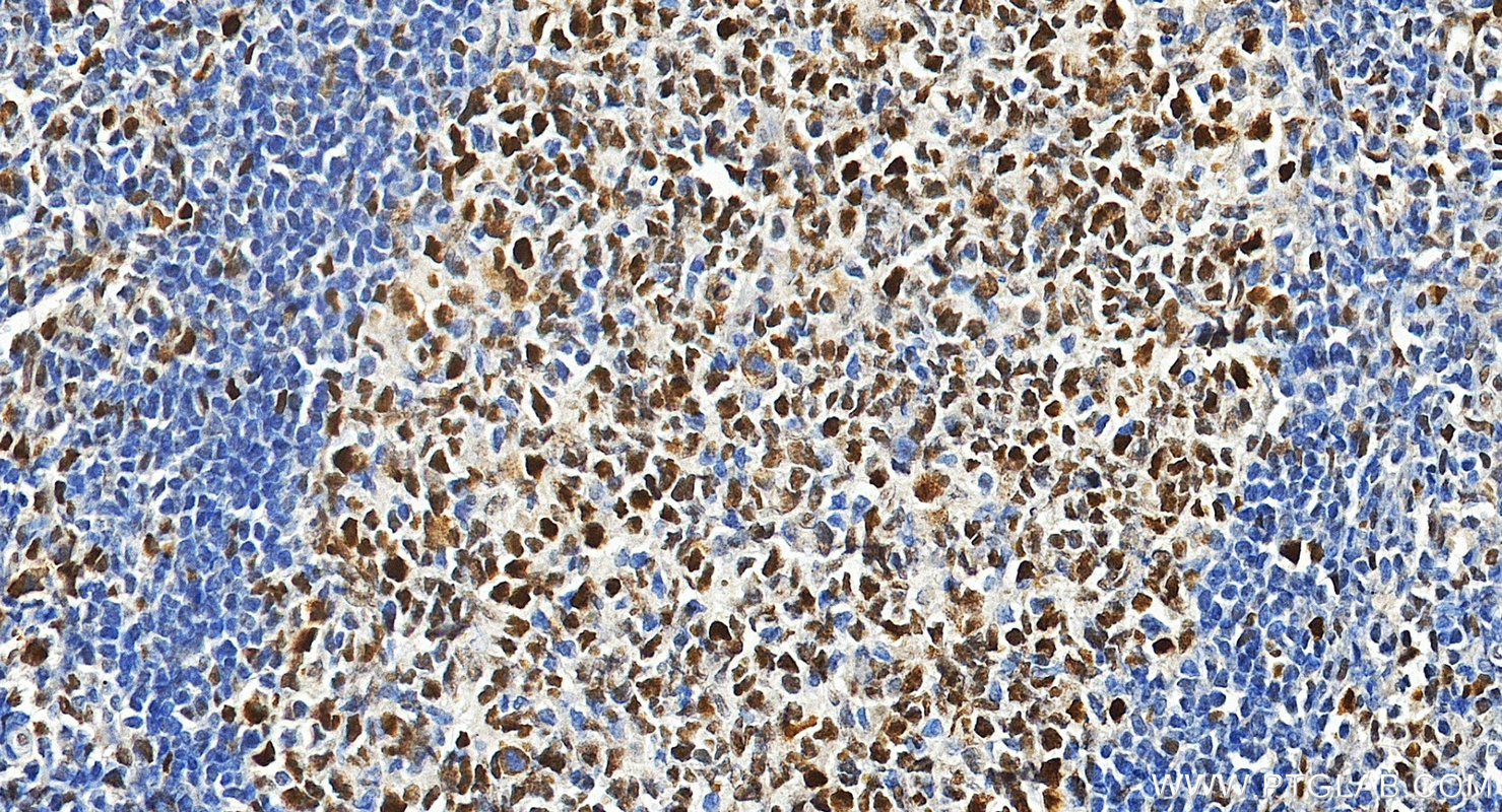 IHC staining of human tonsillitis using 18120-1-AP