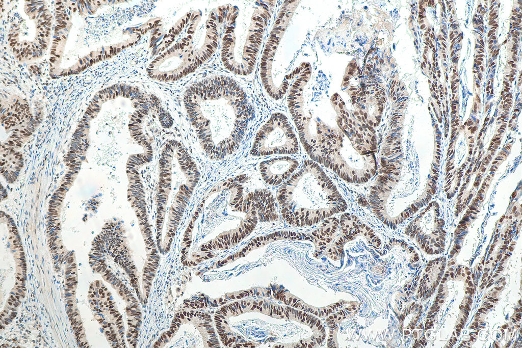 IHC staining of human colon cancer using 66172-1-Ig