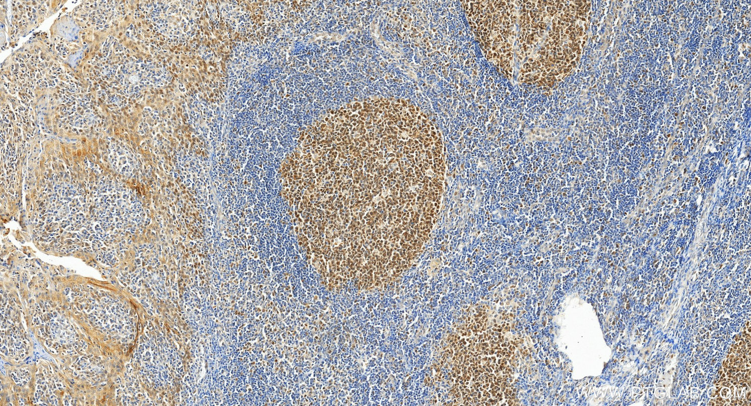 IHC staining of human tonsillitis using 66172-1-Ig