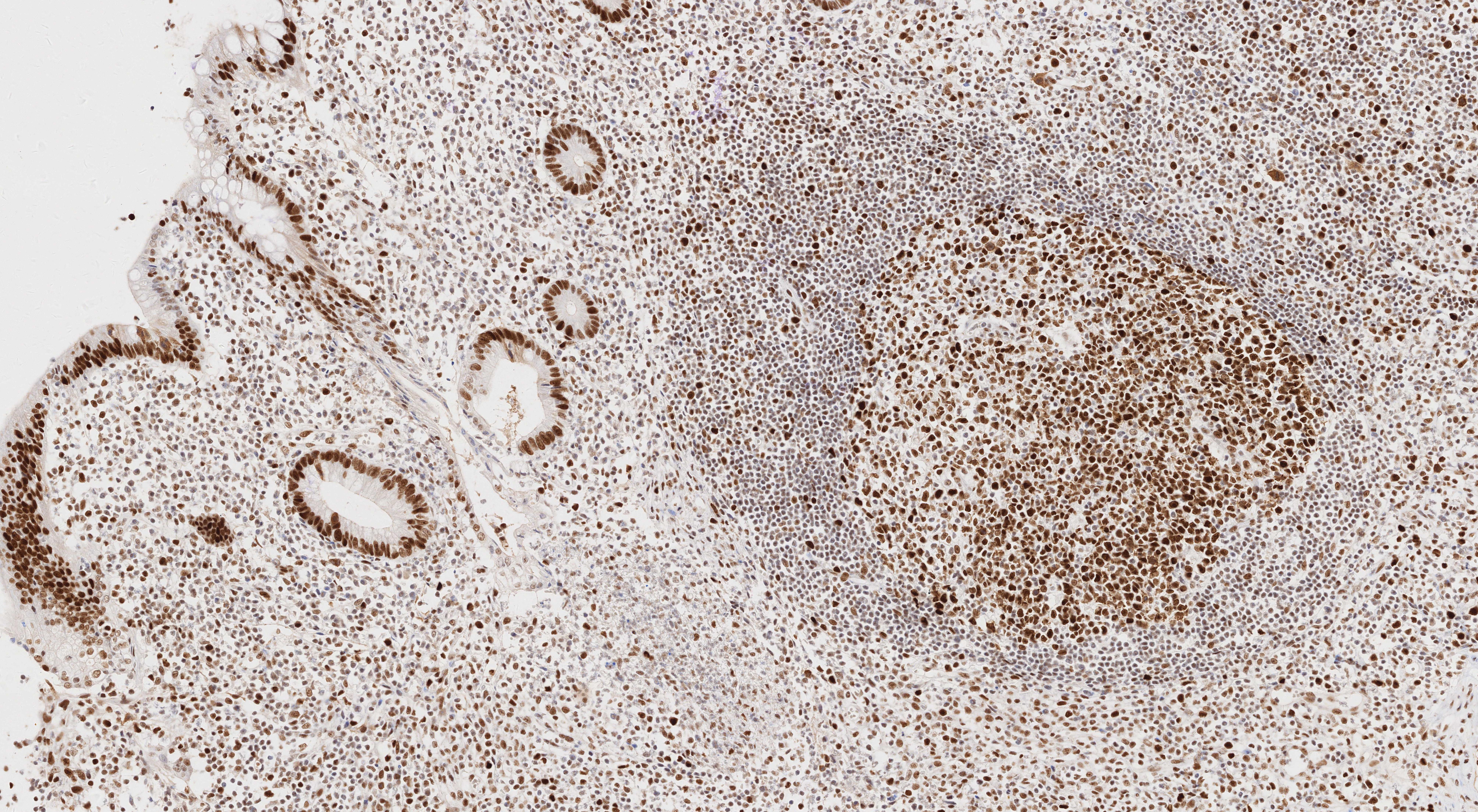 IHC staining of human appendicitis using 66172-2-Ig (same clone as 66172-2-PBS)
