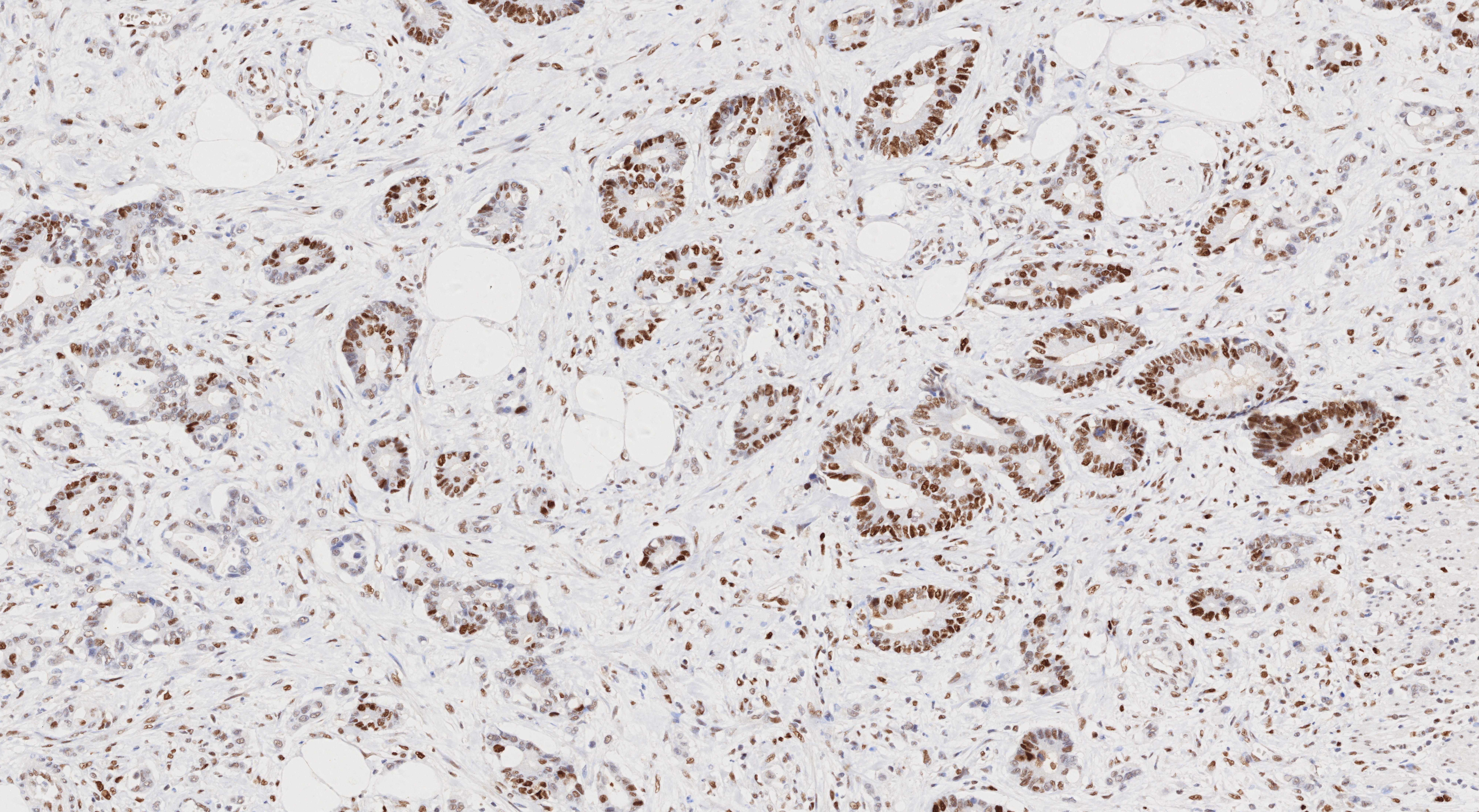 IHC staining of human rectal cancer using 66172-2-Ig (same clone as 66172-2-PBS)