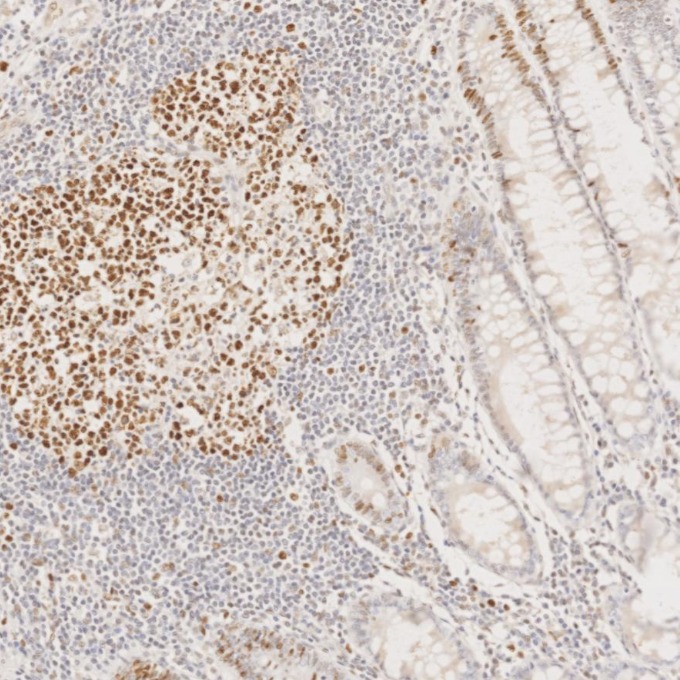 IHC staining of human colorectal cancer using 66172-2-Ig