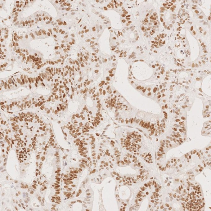 IHC staining of human colorectal cancer using 66172-2-Ig