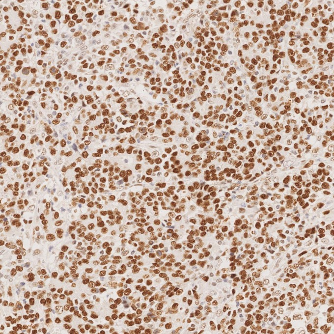 IHC staining of human stomach cancer using 66172-2-Ig