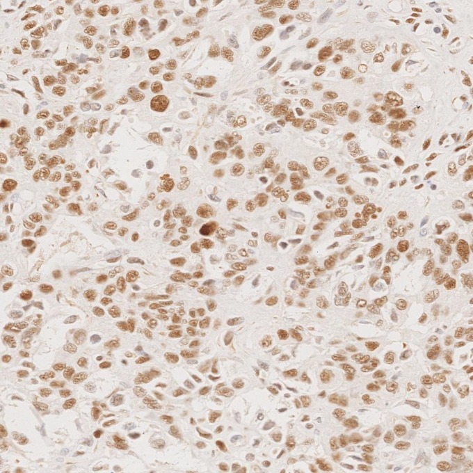 IHC staining of human ovary cancer using 66172-2-Ig