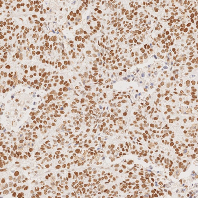 IHC staining of human stomach cancer using 66172-2-Ig