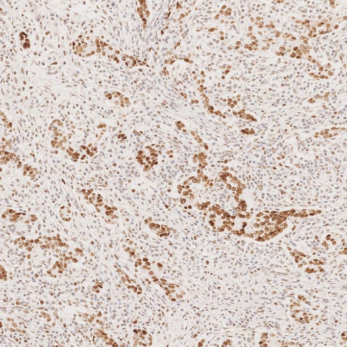 IHC staining of human stomach cancer using 66172-2-Ig