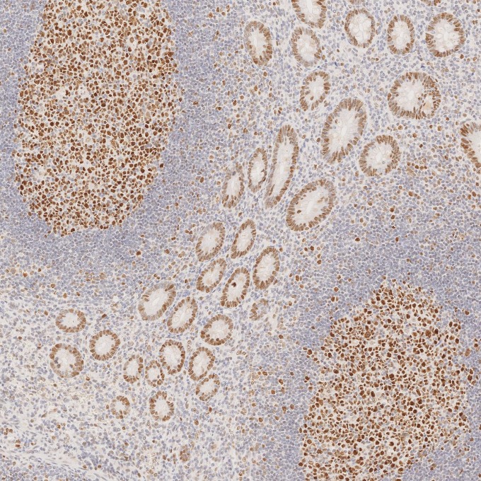 IHC staining of human appendicitis using 66172-2-Ig