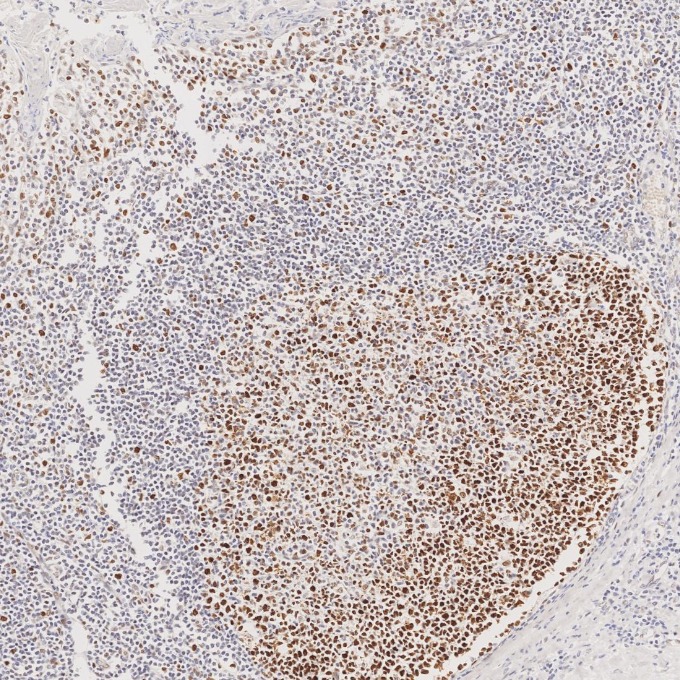 IHC staining of human tonsillitis using 66172-2-Ig