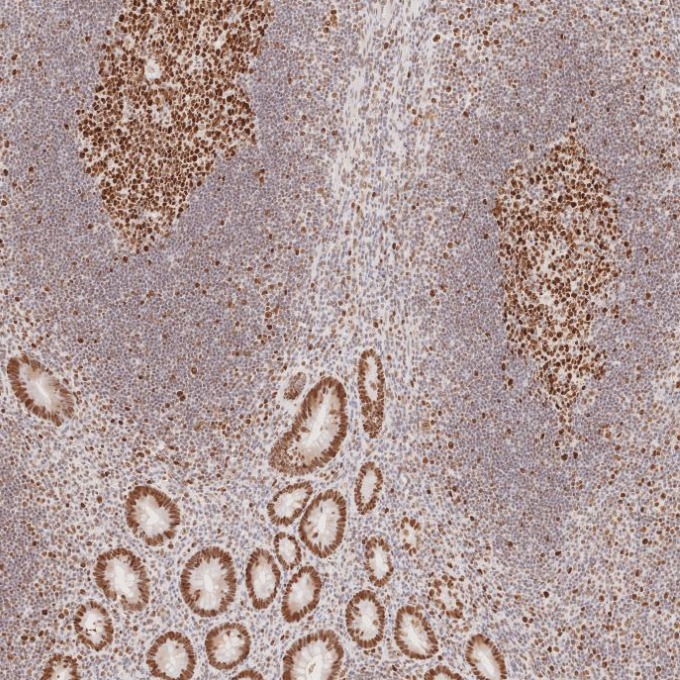 IHC staining of human appendicitis using 66172-2-Ig