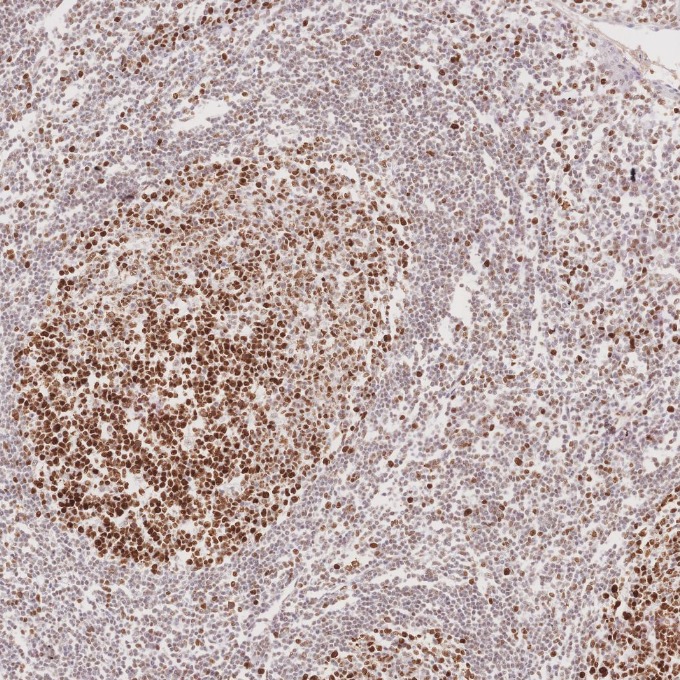 IHC staining of human tonsillitis using 66172-2-Ig